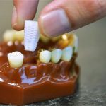 Rút ngắn thời gian trồng răng giả nhờ chân răng 3D