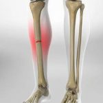 Phát hiện tế bào gốc giúp sửa chữa các chấn thương xương