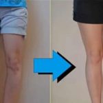 Chân cong biến thành chân thẳng: Hoá ra người ta đã phải chịu đau đến thế này đây