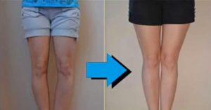 Chân cong biến thành chân thẳng: Hoá ra người ta đã phải chịu đau đến thế này đây