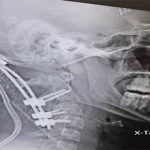 Chàng trai 22 tuổi gây chấn động y học vì sống sót sau tai nạn “suýt rụng đầu”