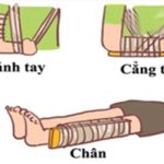 Hướng dẫn sơ cứu đúng cách cho trẻ bị gãy xương