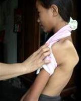 Điều trị teo cơ Delta bằng vật lý trị liệu