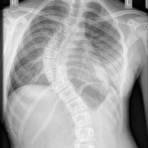 Nữ sinh bị vẹo cột sống 90 độ