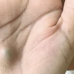 Phát hiện cục bướu lạ ở tay, người đàn ông suýt tử vong vì chứng bệnh nguy hiểm