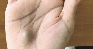 Phát hiện cục bướu lạ ở tay, người đàn ông suýt tử vong vì chứng bệnh nguy hiểm