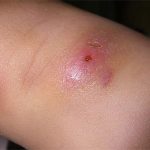 Dấu hiệu nhiễm trùng tụ cầu khuẩn bất kì ai cũng không được bỏ qua