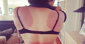 Bác sĩ da liễu gợi ý 3 cách nhanh nhất loại bỏ vết cháy nắng