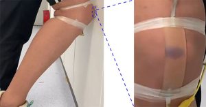 Phát triển thành công da nhân tạo có thể bầm tím như thật