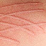 Nguyên nhân nổi mề đay không phải ai cũng biết