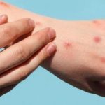 Rác thải y tế có thể khiến virus bệnh đậu mùa khỉ lây lan