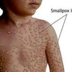 Nguy cơ phân tán virus đậu mùa qua vũ khí sinh học