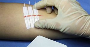 Dermaclip – Miếng dán vết thương cho những người sợ đau