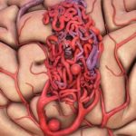 Đột biến gene – nguyên nhân gây dị dạng mạch máu não thể hang