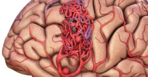 Đột biến gene – nguyên nhân gây dị dạng mạch máu não thể hang