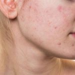 Cách xử lý khi bị dị ứng da mặt