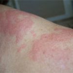 Sự thật ít biết về dị ứng