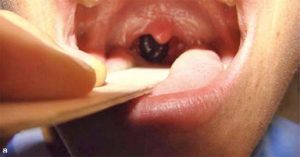 Chuyện kinh dị có thật: điều gì sẽ xảy ra nếu bị đỉa ký sinh trong họng?