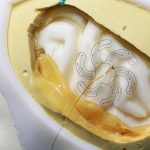 Điện cực hình bông hoa mở ra khả năng phẫu thuật não điều trị thần kinh với xâm lấn tối thiểu