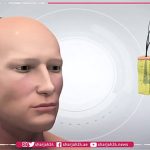 Điều trị hói đầu nhờ công nghệ in 3D