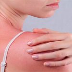 Ngộ độc ánh nắng mặt trời – tình trạng nguy hiểm cần được nhận biết ngay