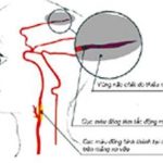 Hẹp động mạch cảnh – một trong những nguyên nhân gây tai biến mạch máu não