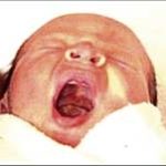 Đột tử sơ sinh do rối loạn gien?