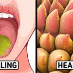 Mẹo chữa bỏng lưỡi khi ăn uống phải món nóng