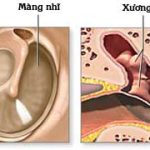 Biểu hiện của thủng màng nhĩ