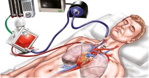 ECMO là gì? Khi nào bệnh nhân cần can thiệp ECMO?
