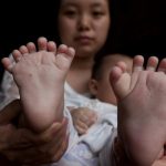 Em bé 4 tháng tuổi có 31 ngón