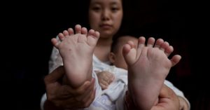 Em bé 4 tháng tuổi có 31 ngón