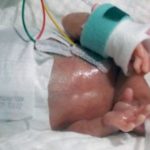 Em bé sinh non nhẹ nhất thế giới