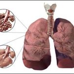 Phương pháp điều trị mới giúp ích cho người bị khí phế thủng