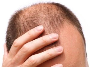 Thuốc trị hói đầu làm tăng nguy cơ trầm cảm