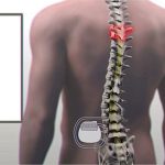 Đột phá y học: Lần đầu tiên bệnh nhân liệt cột sống có thể đi lại