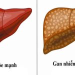 Triệu chứng và cách phòng ngừa gan nhiễm mỡ độ 2