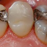 Hàn răng nhiều lần sẽ khiến bạn nhận một kết cục vô cùng đáng sợ