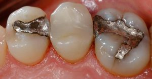 Hàn răng nhiều lần sẽ khiến bạn nhận một kết cục vô cùng đáng sợ