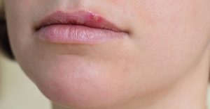 WHO cảnh báo: 50% dân số thế giới có thể mắc bệnh Herpes