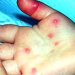Châu Á quan ngại sự bùng phát bệnh chân tay miệng