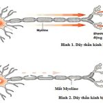 Liệt cơ tức thời bởi hội chứng Guillain – Barré