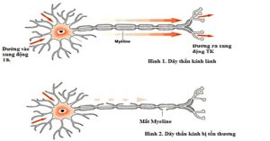 Liệt cơ tức thời bởi hội chứng Guillain – Barré