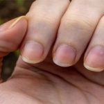 Dấu hiệu ít được chú ý trên móng tay có thể cảnh báo bạn về bệnh ung thư