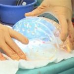 Hà Lan: Cấy ghép thành công hộp sọ 3D cho một phụ nữ