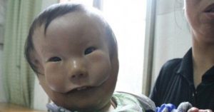 Mắc dị tật cực hiếm, em bé mang hai khuôn mặt