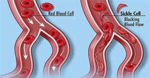 Cấy virus HIV vào tủy để cứu những bệnh nhân chết dần chết mòn vì nghẹt thở