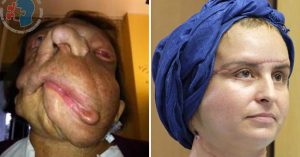 Người phụ nữ mang gương mặt quỷ trở nên xinh đẹp đến bất ngờ sau 3 năm