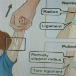 Kéo giật tay trẻ đột ngột dễ làm trật khớp khuỷu