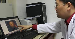 4 khối bã thức ăn to như quả trứng trong dạ dày người phụ nữ